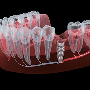 Illustration of dental implant placed in gum tissue