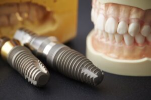 Dental implants next to a mold of a mouth. 